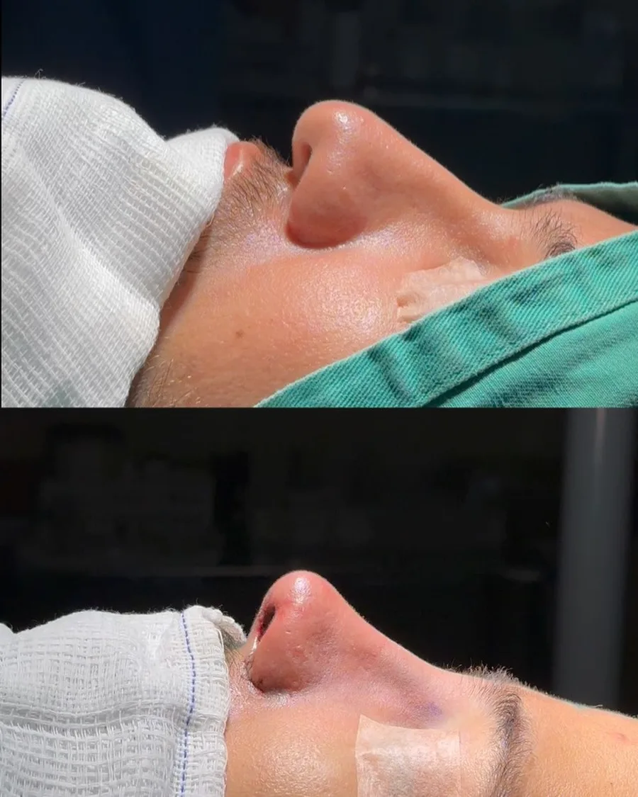 Perfil de paciente antes e logo após a rinoplastia