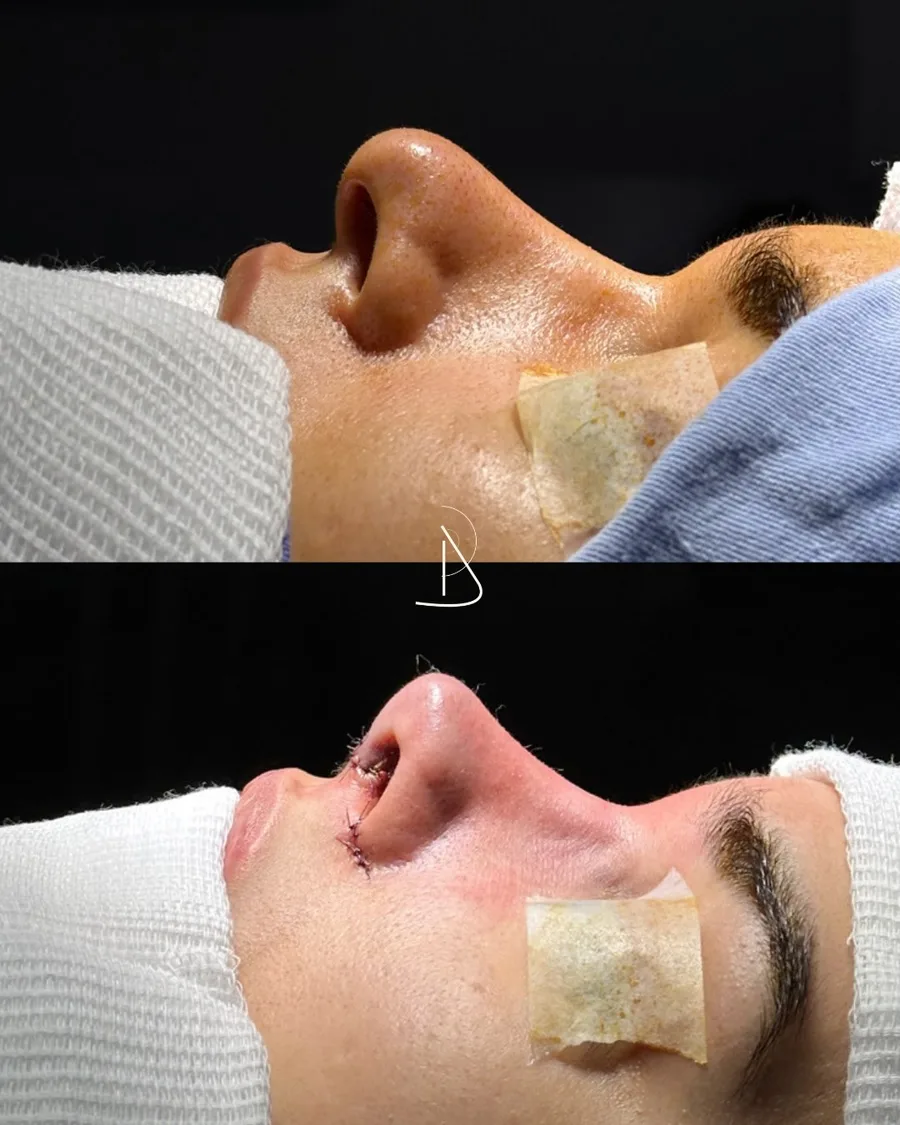 Perfil de paciente antes e logo após a rinoplastia