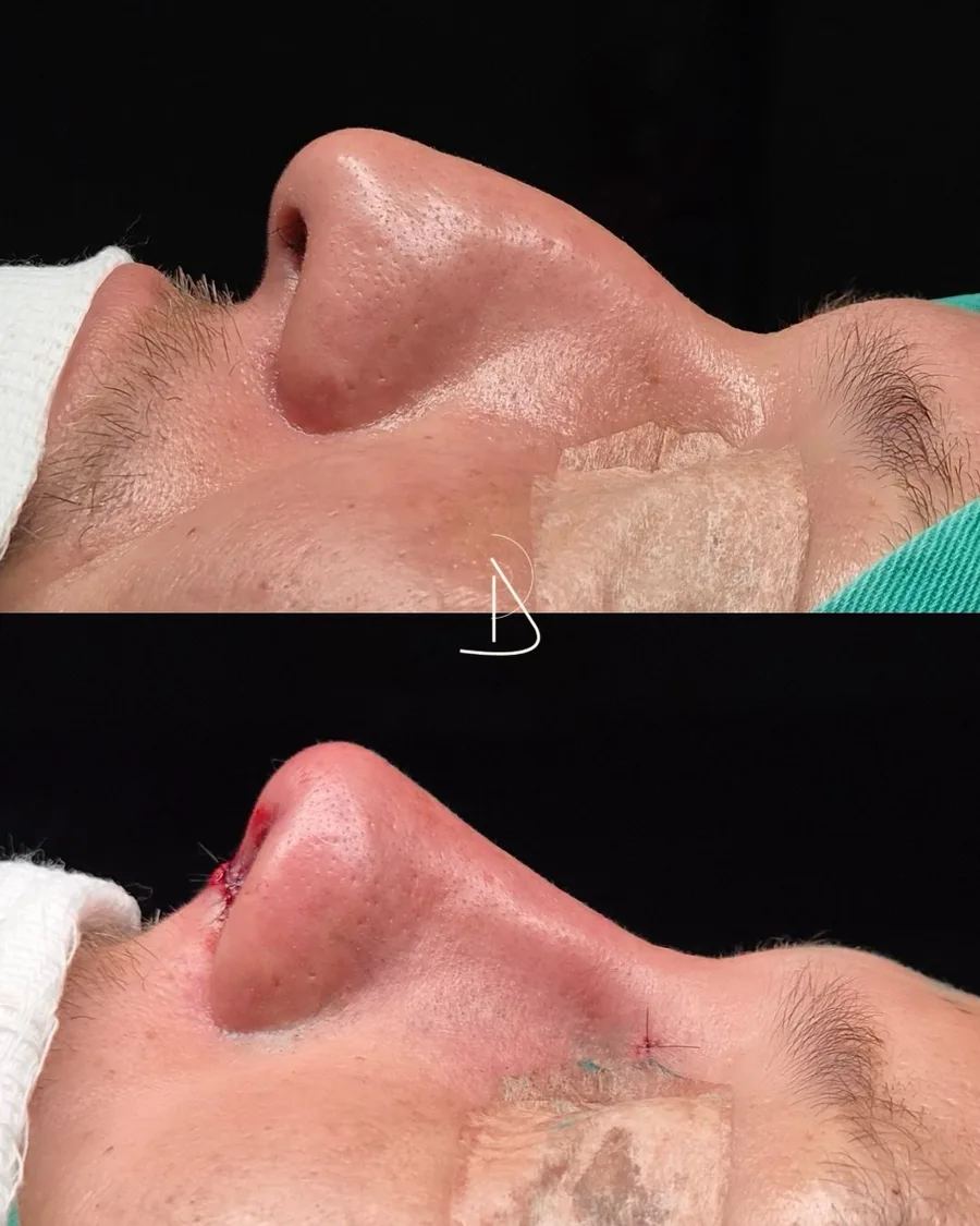 Perfil de paciente antes e logo após a rinoplastia